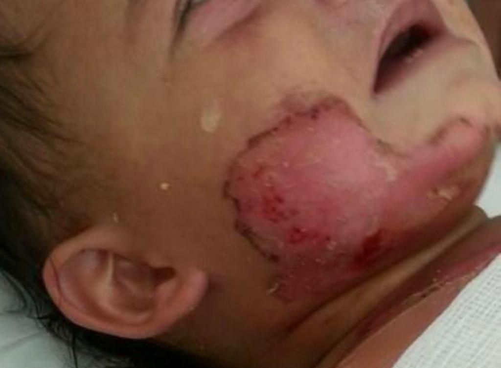 Close-up of a person's face, focusing on the lips, nose, and chin. Skin is fair.