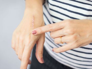 Person pointing to a scar on their hand, wearing a ring, against a striped shirt.