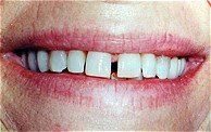 Porcelain Veneers - AFTER
