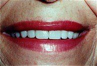 Porcelain Veneers - AFTER