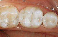 Removal of Amalgam / Silver Fillings and Replaced with Natural Tooth Colored Fillings - AFTER