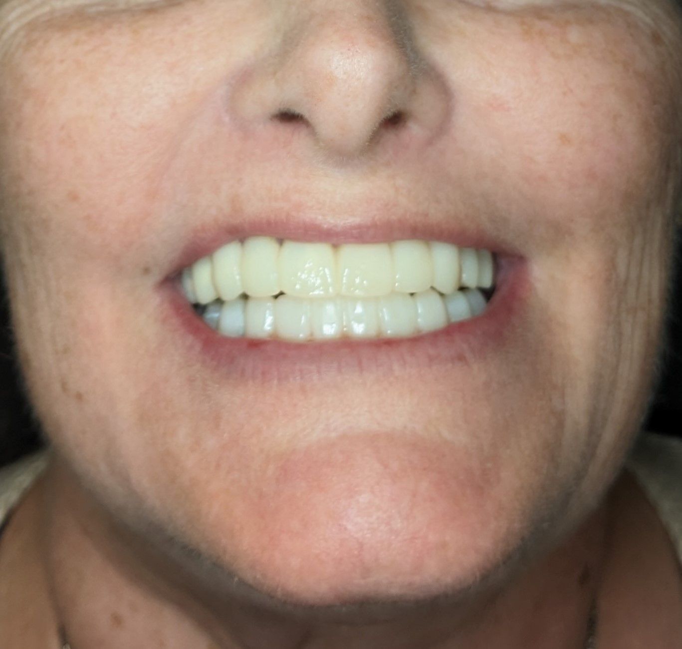 Dental Implant - After Tooth