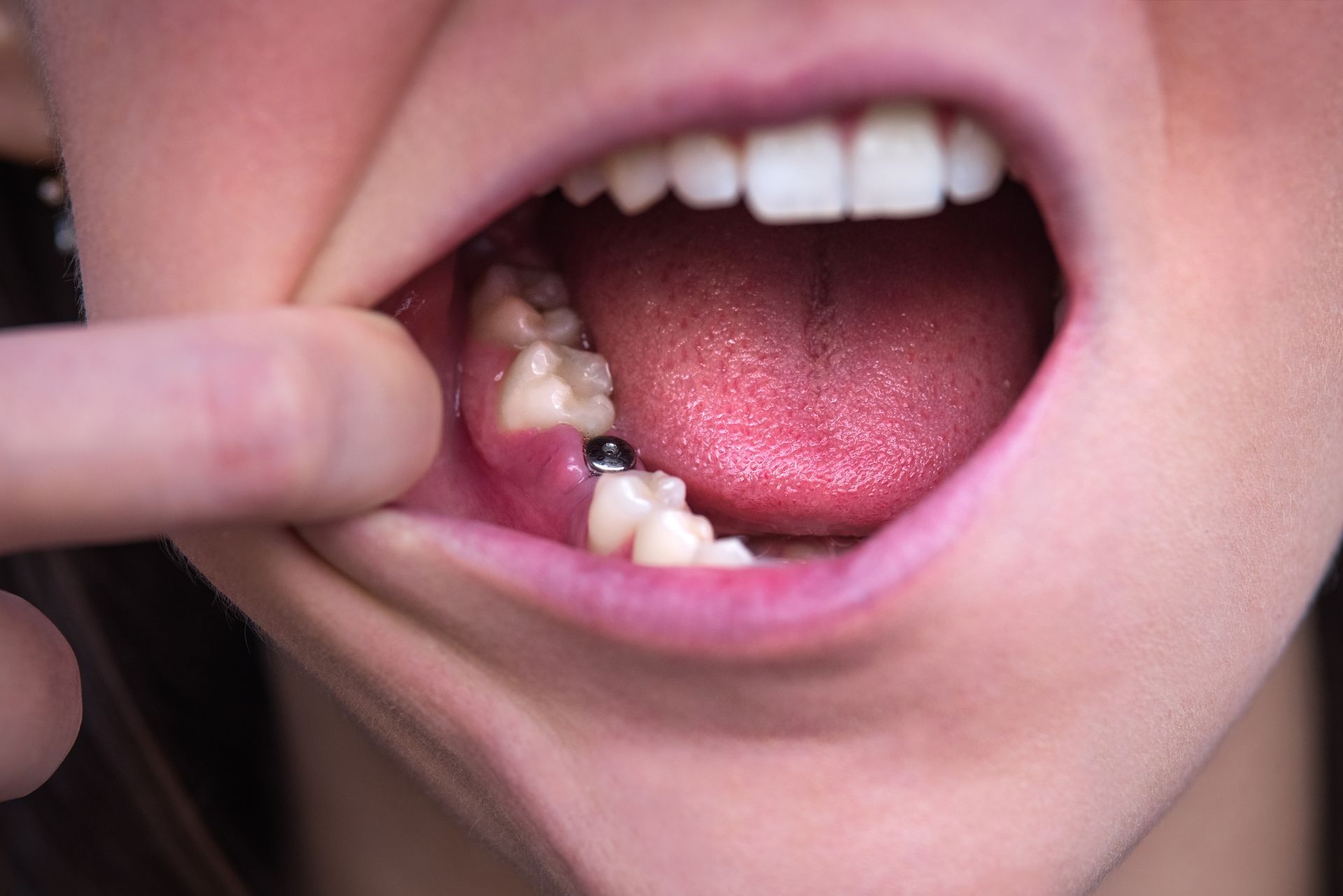 A person opens their mouth, showing a missing tooth and a dental implant.