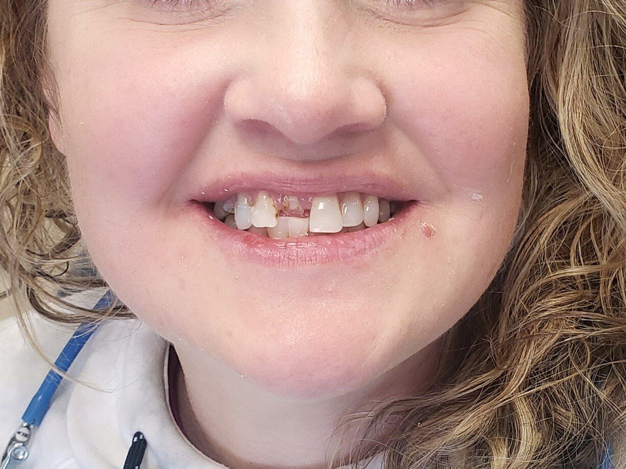 A close up of a woman 's mouth with missing teeth.