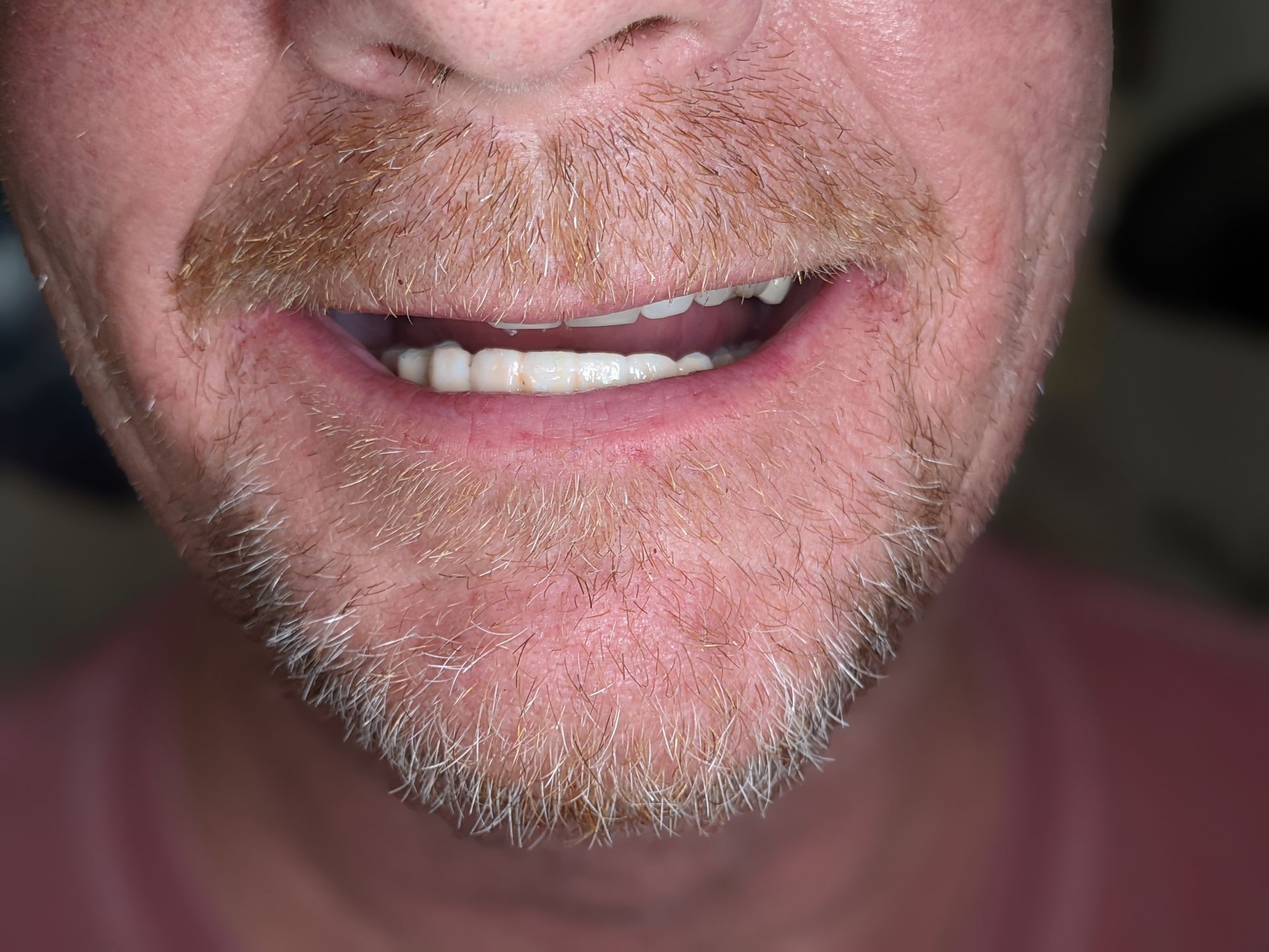 Dental Implant - After Tooth