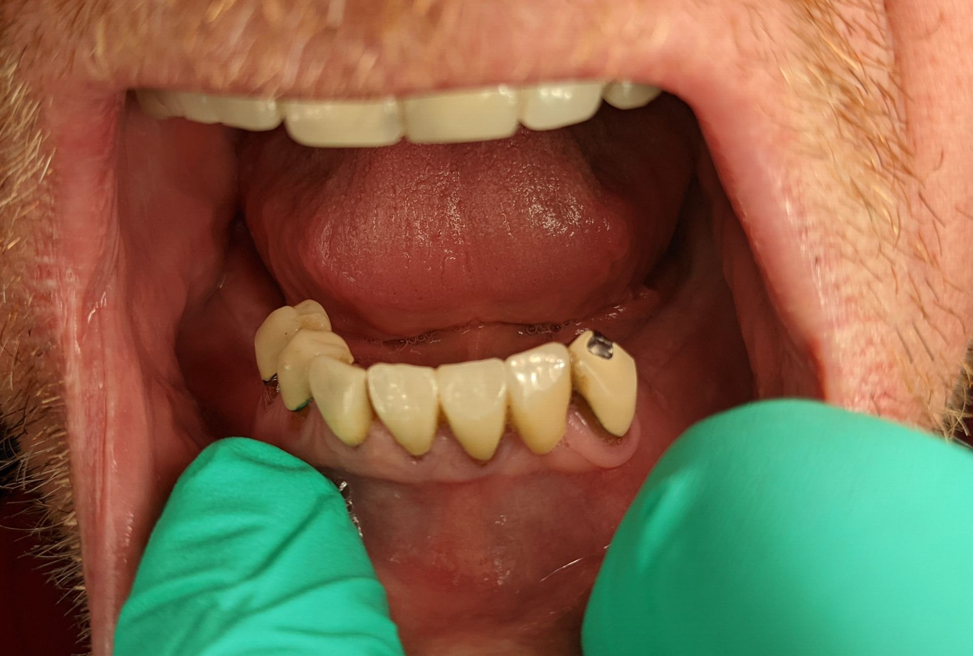 Dental Implant - Before Tooth