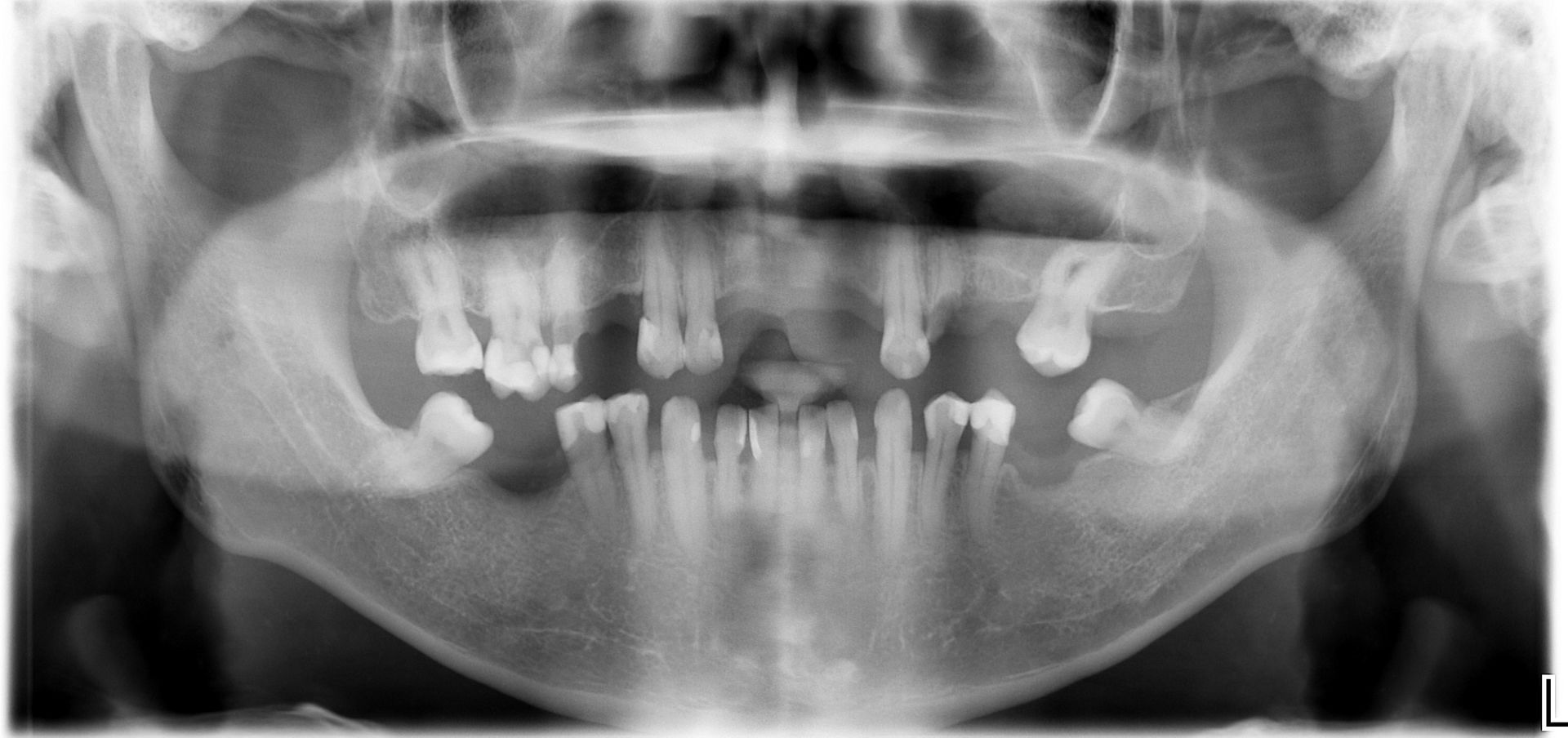 Dental Implant - Before Tooth