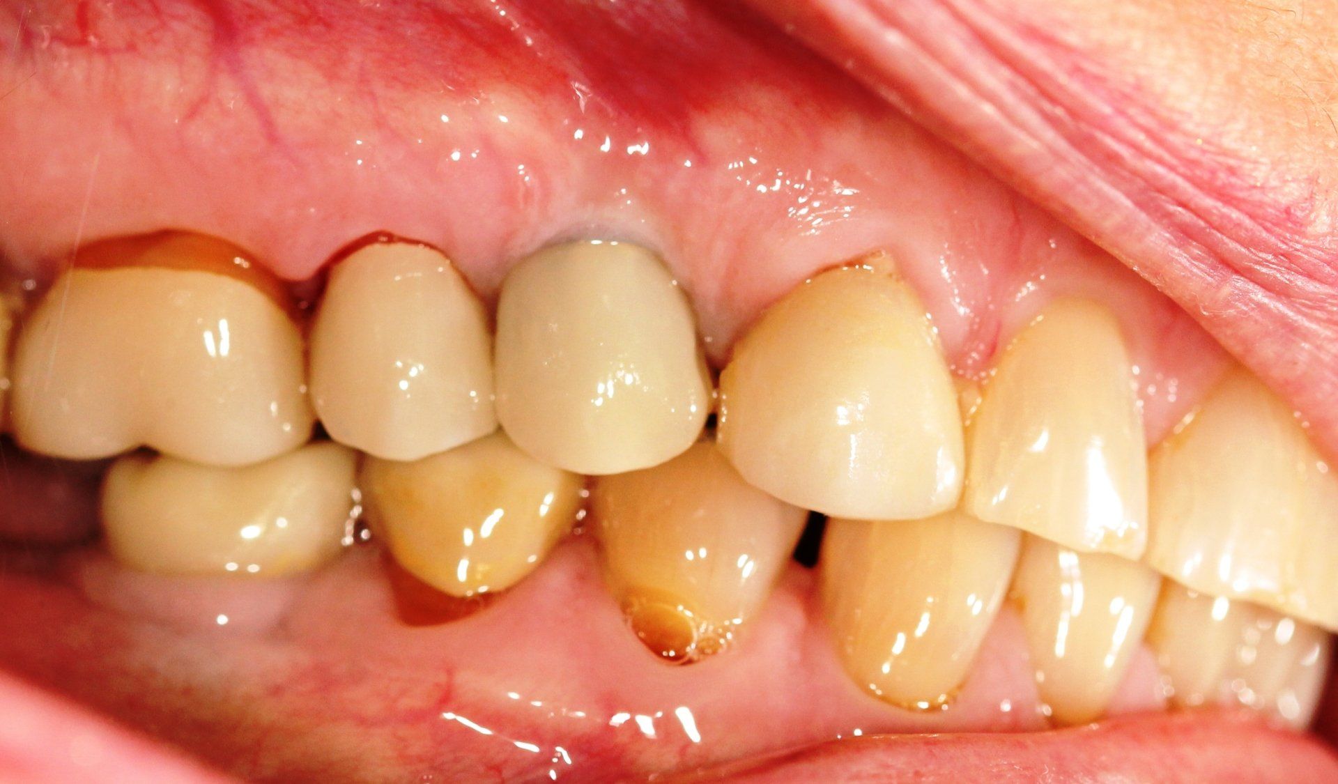 Dental Implant - After Tooth