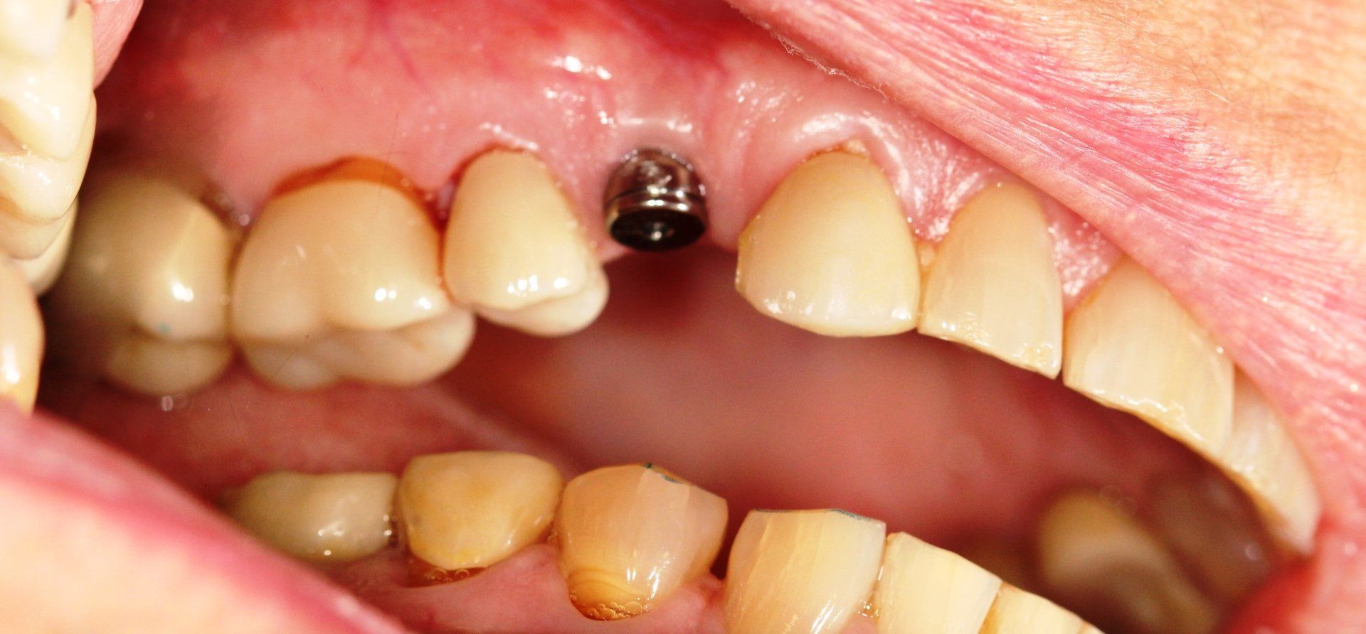 Dental Implant - Before Tooth