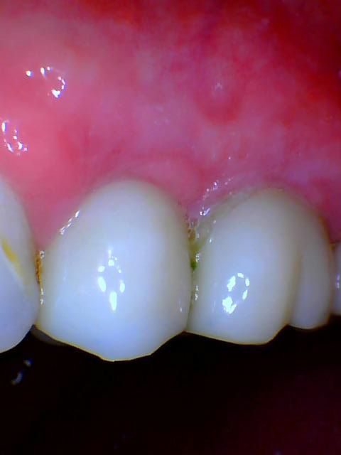 Dental Implant - After Tooth
