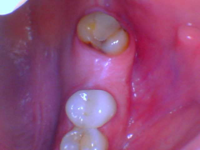 Dental Implant - Before Tooth