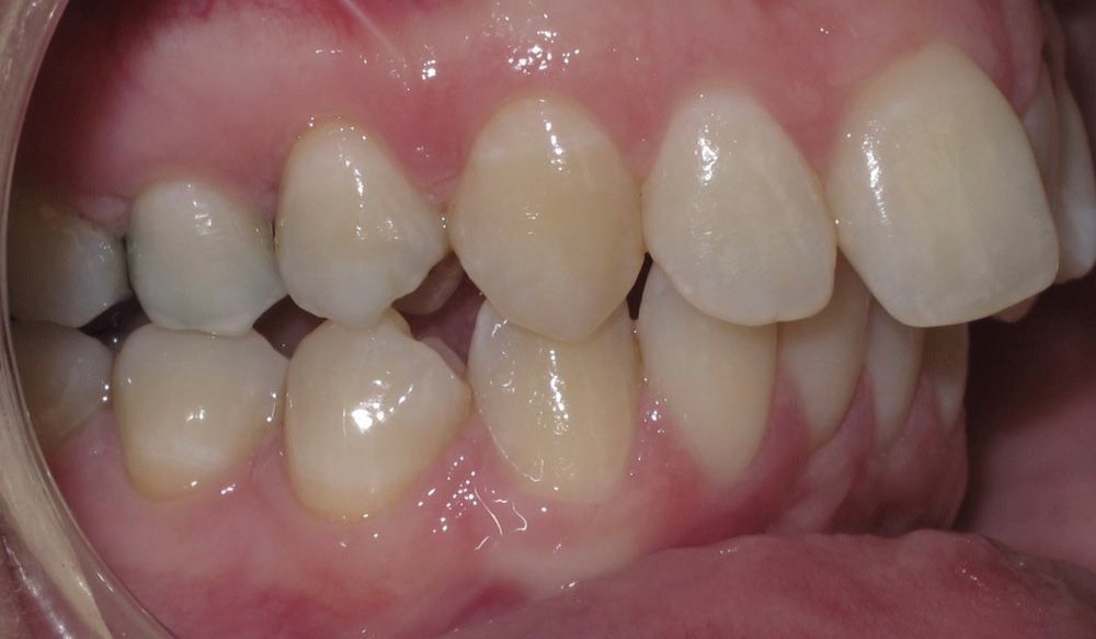 A close up of a person 's teeth and gums.