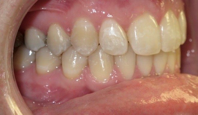 A close up of a person 's teeth and mouth.