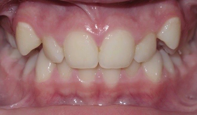 A close up of a person 's teeth with a broken tooth.