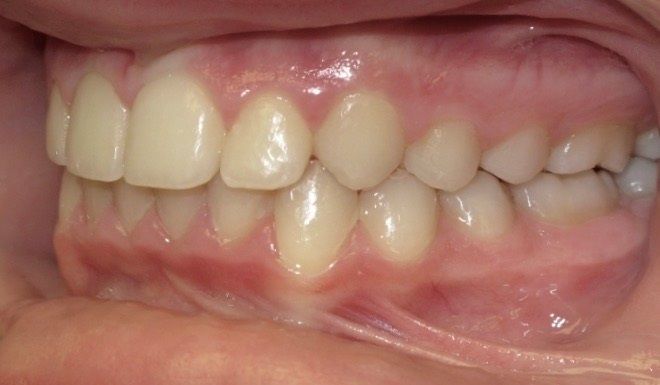 A close up of a person 's teeth and gums.