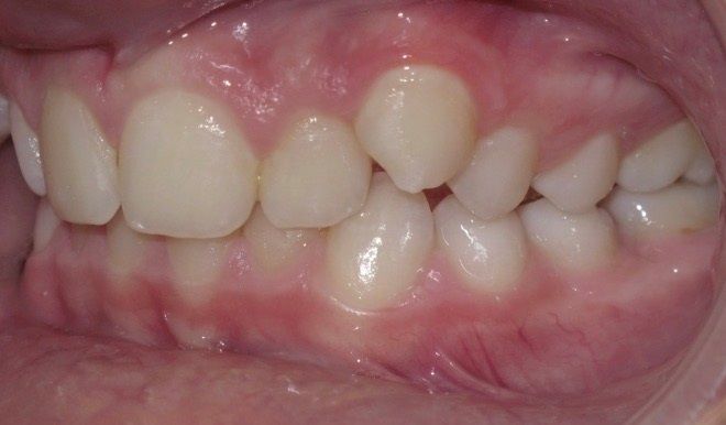 A close up of a person 's teeth and gums.