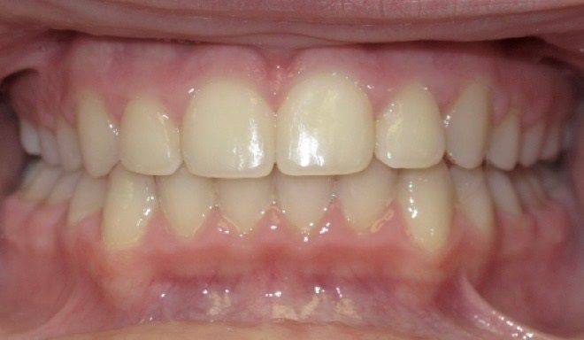 A close up of a person 's teeth with white teeth.