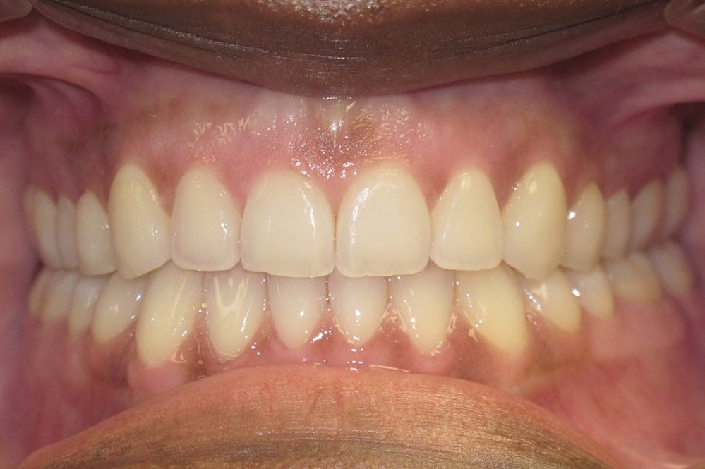 A close up of a person 's teeth with white teeth.