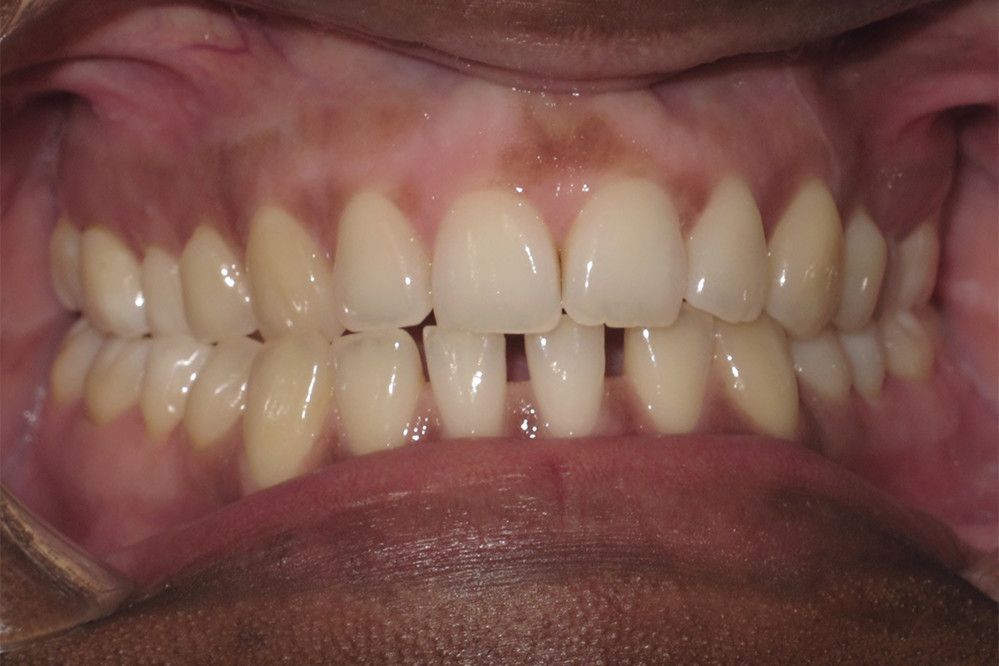 A close up of a person 's teeth and mouth.