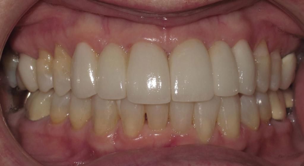 A close up of a person 's teeth with white teeth.