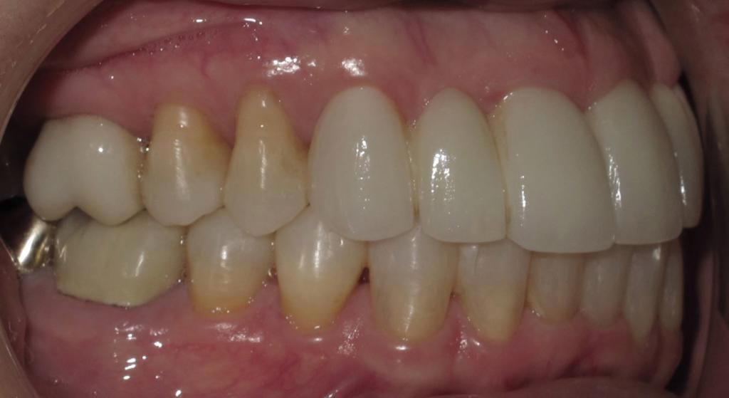 A close up of a person 's teeth with a mouth mirror.