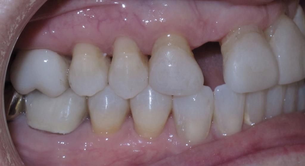 A close up of a person 's teeth with a missing tooth