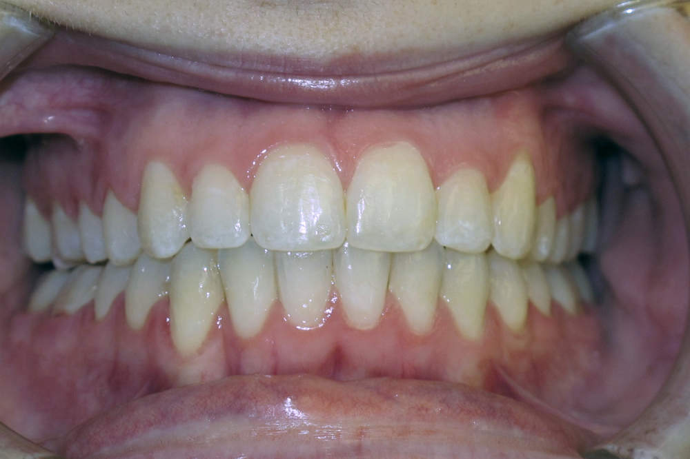 A close up of a person 's mouth with white teeth.