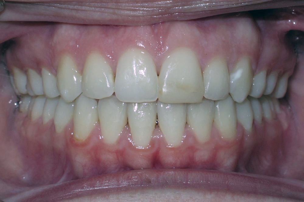 A close up of a person 's teeth with white teeth.