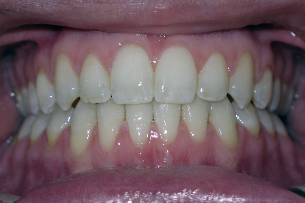 A close up of a person 's teeth with white teeth