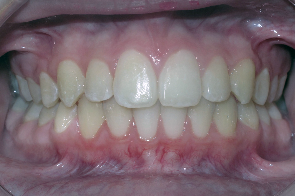 A close up of a person 's teeth and gums.