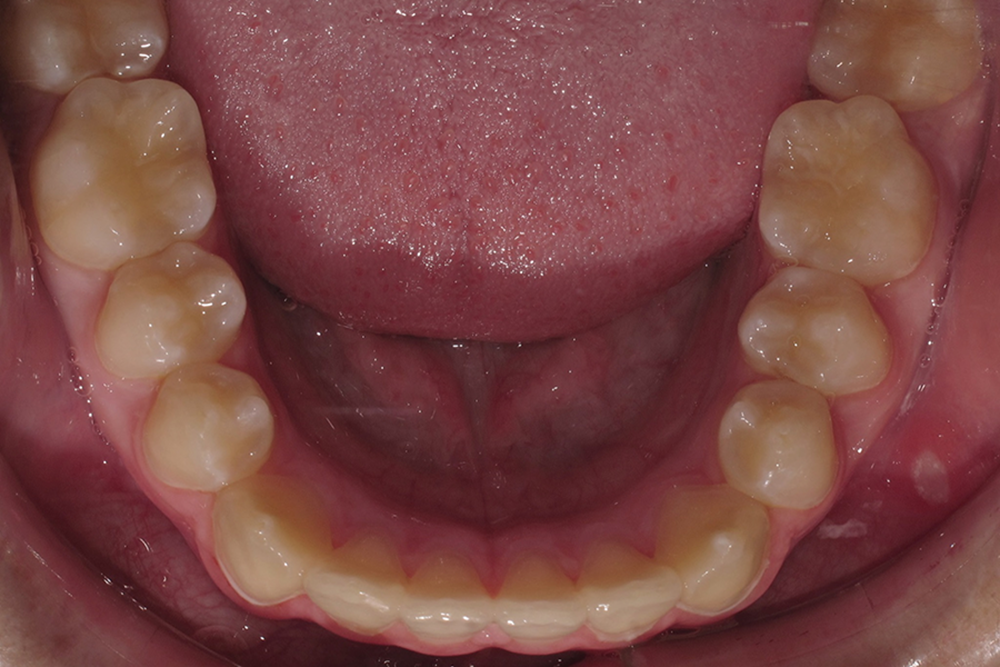 A close up of a person 's teeth and tongue.