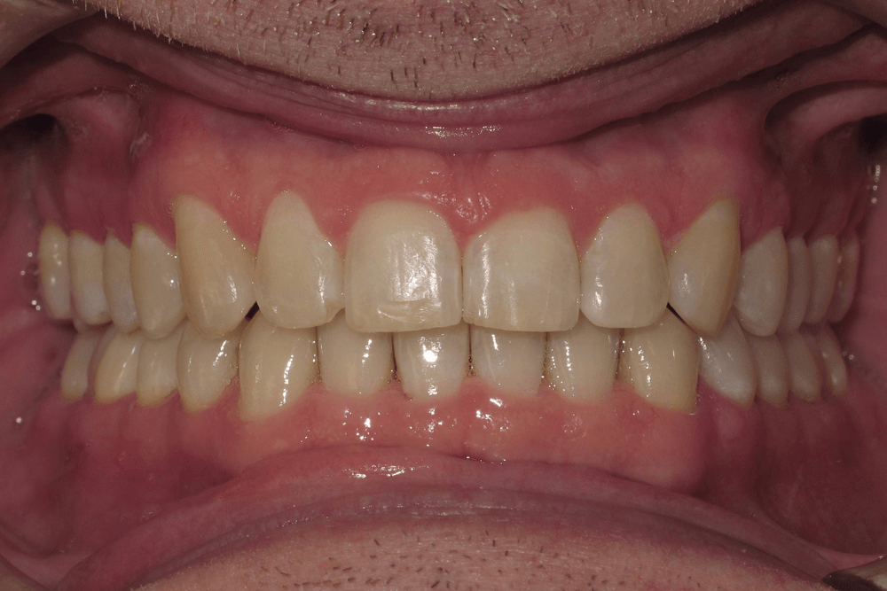 A close up of a man 's teeth with a missing tooth.