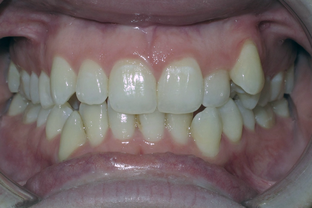 A close up of a person 's teeth with a broken tooth.