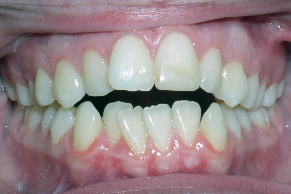 A close up of a person 's teeth with a black spot in the middle.