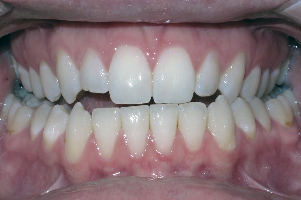 A close up of a person 's mouth with white teeth.