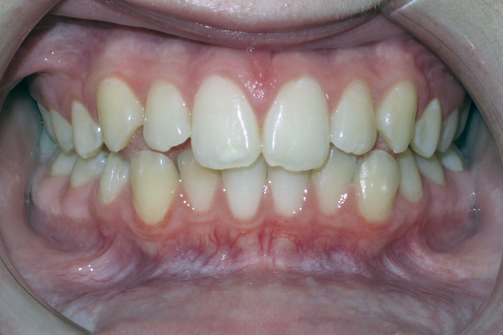 A close up of a person 's teeth with white teeth.