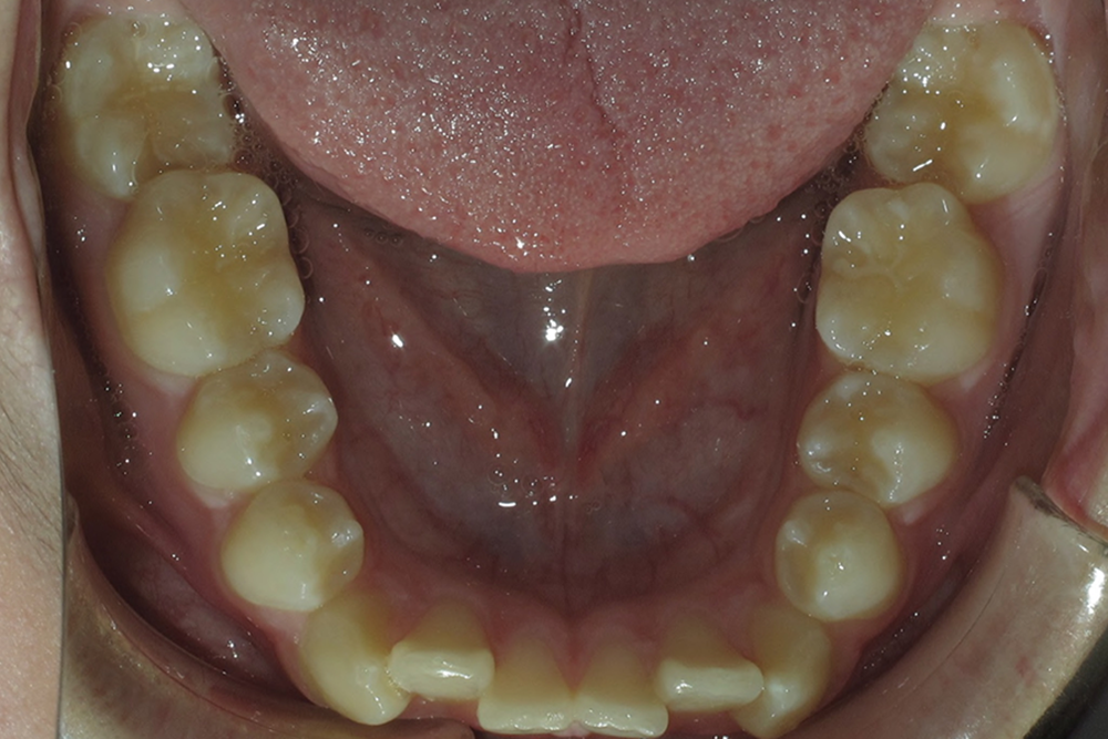 A close up of a person 's teeth with their tongue out