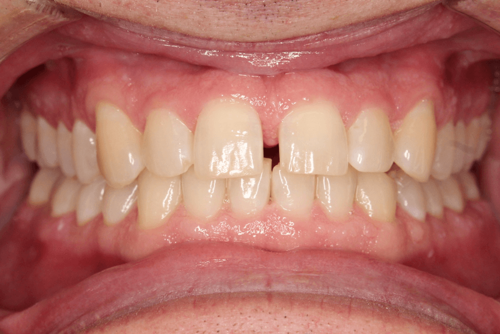 A close up of a man 's teeth with a missing tooth.