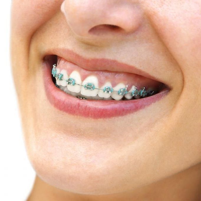 A close up of a woman 's mouth with braces on her teeth.