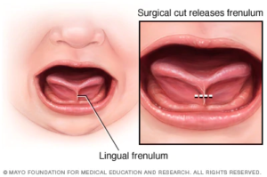 An illustration of a baby 's mouth showing a surgical cut and a lingual frenulum