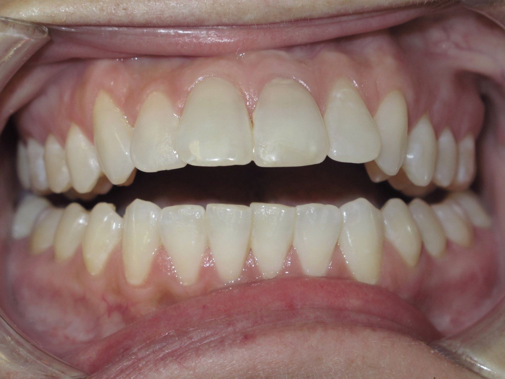 A close up of a person 's teeth with white teeth.