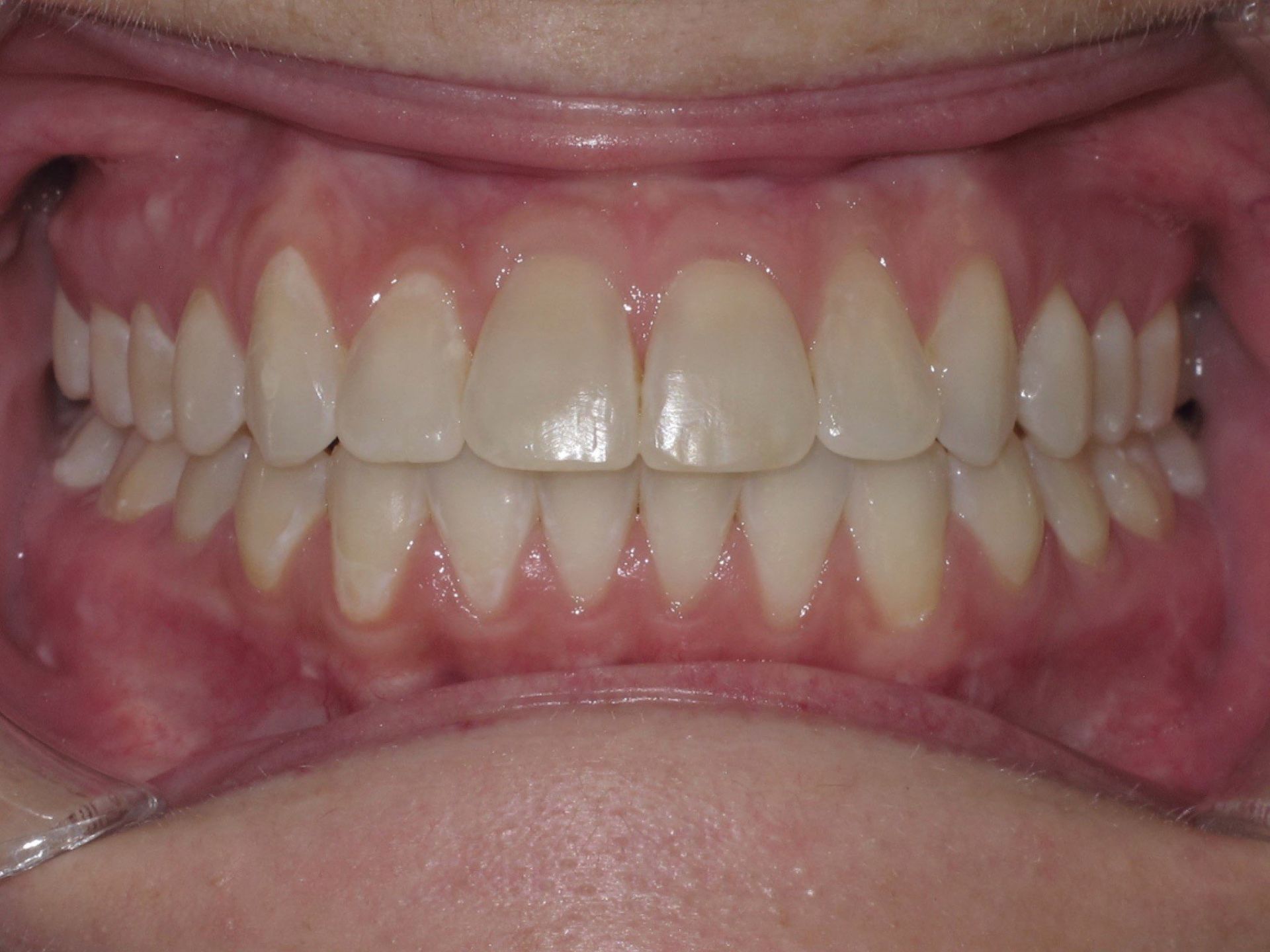 A close up of a person 's teeth and mouth.