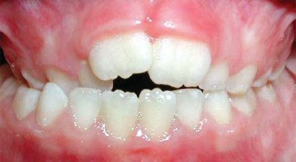 A close up of a child 's teeth with a broken tooth.