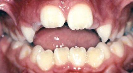 A close up of a child 's teeth with their mouth open.