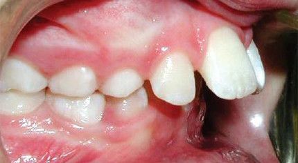 A close up of a person 's mouth with their teeth showing.