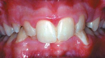 A close up of a person 's teeth and gums.