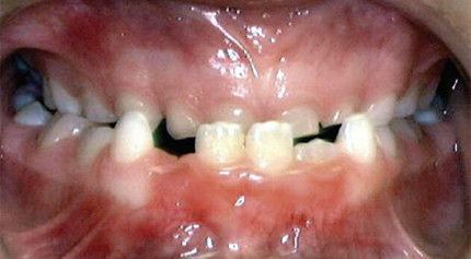 A close up of a person 's mouth with a black arrow pointing to the teeth.