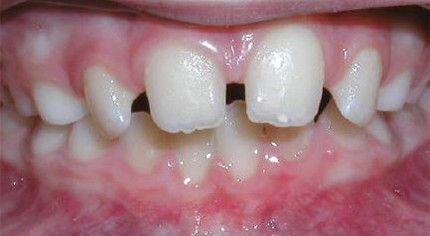 A close up of a child 's teeth with a missing tooth.