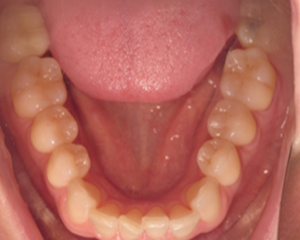 A close up of a person 's teeth with their tongue sticking out