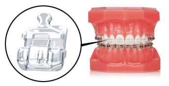 A model of a person 's teeth with braces on them.